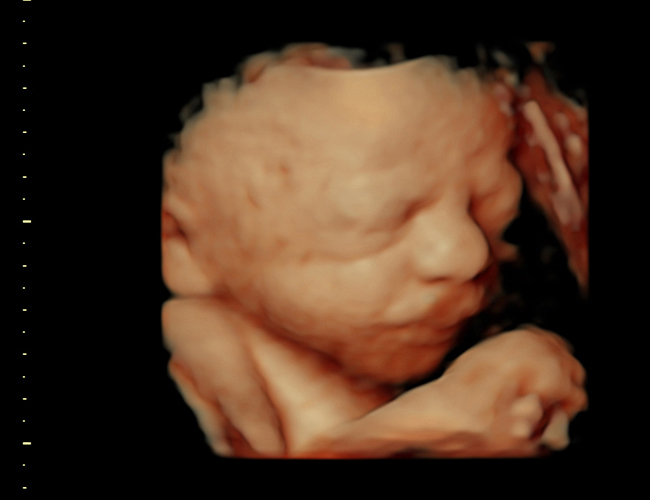 3D ultrasound image at 31 weeks